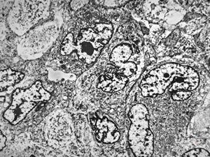 M,51y. | myosarcoma v.s. - scrotum M,51y. | myosarcoma v.s. - scrotum